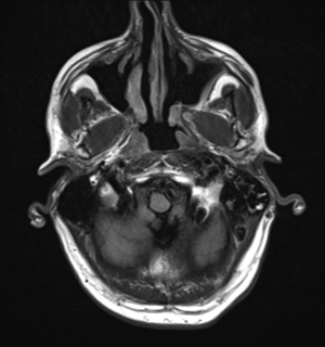 File:Cerebral metastasis - melanoma (Radiopaedia 54718-60954 Axial FLAIR 4).png