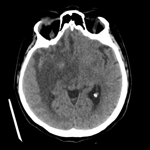 Cerebral metastasis to basal ganglia (Radiopaedia 81568-95412 Axial non-contrast 30).png