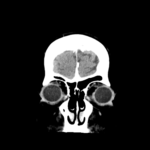 Cerebral metastasis to basal ganglia (Radiopaedia 81568-95412 Coronal C+ delayed 9).png