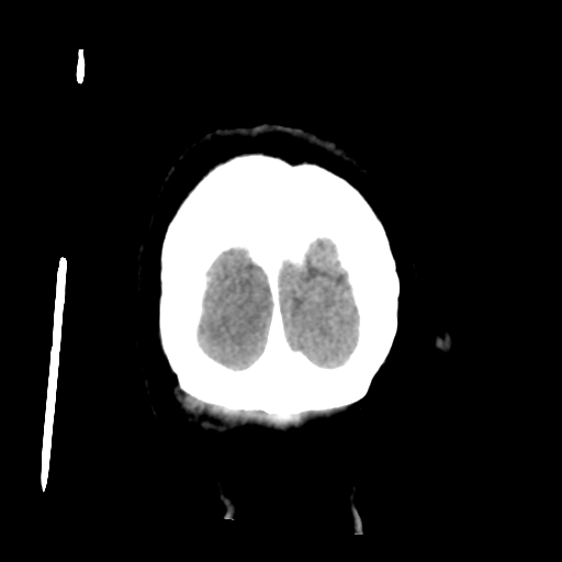 Cerebral metastasis to basal ganglia (Radiopaedia 81568-95412 Coronal non-contrast 61).png