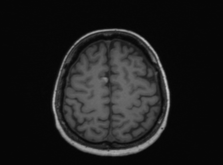 Cerebral ring enhancing lesions - cerebral metastases (Radiopaedia 44922-48817 Axial T1 150).jpg