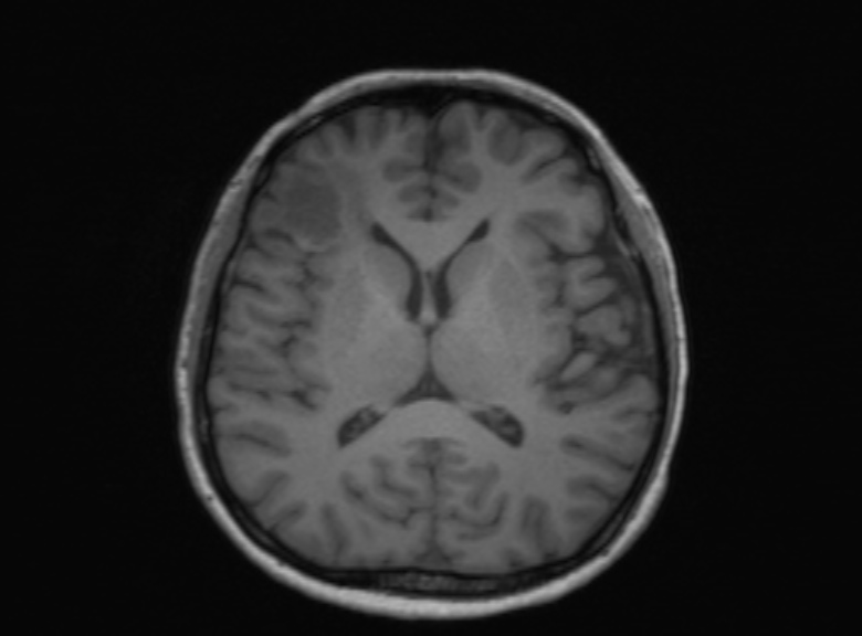 Cerebral ring enhancing lesions - cerebral metastases (Radiopaedia 44922-48817 Axial T1 215).jpg