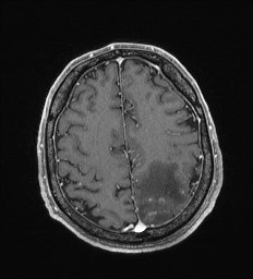 Cerebral toxoplasmosis (Radiopaedia 43956-47461 Axial T1 C+ 59).jpg