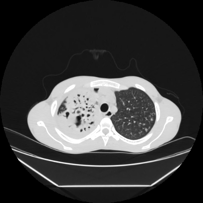 Cerebral tuberculoma (Radiopaedia 80829-94318 Axial lung window 39).jpg