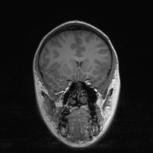 Cerebral tuberculosis with dural sinus invasion (Radiopaedia 60353-68090 Coronal T1 68).jpg