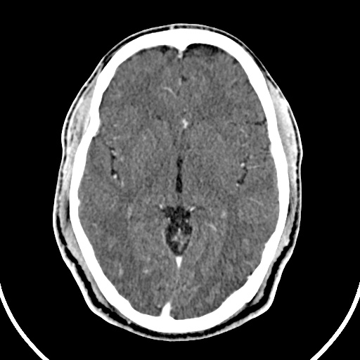 Cerebral venous angioma (Radiopaedia 69959-79977 B 41).jpg