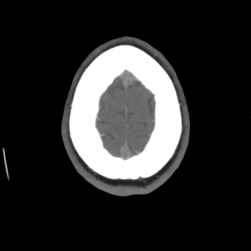 File:Cerebral venous infarct related to dural venous sinus thromboses (Radiopaedia 35292-36804 Axial C+ delayed 45).png
