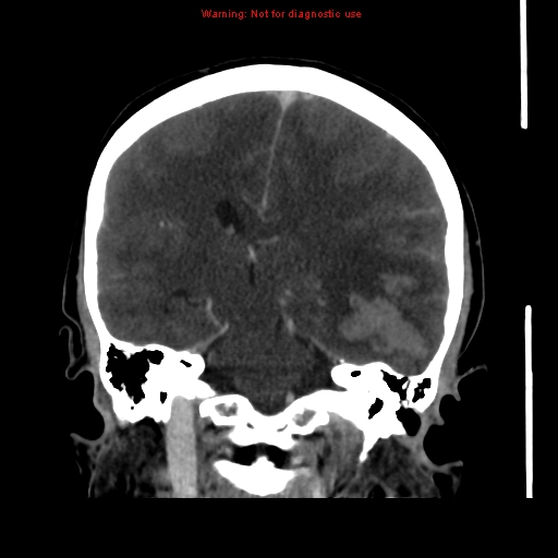Cerebral venous infarction (Radiopaedia 12404-20735 B 47).jpg