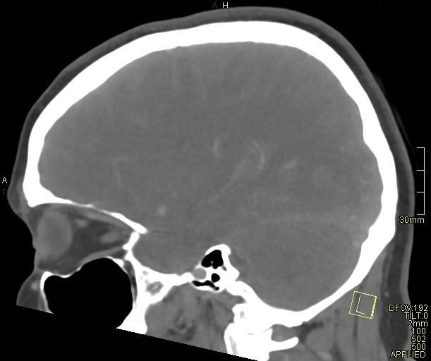 Cerebral venous sinus thrombosis (Radiopaedia 91329-108965 Sagittal venogram 50).jpg