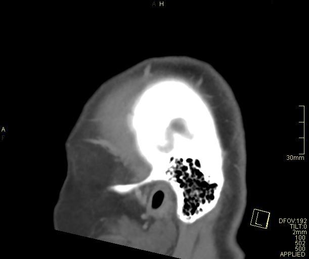 Cerebral venous sinus thrombosis (Radiopaedia 91329-108965 Sagittal venogram 70).jpg