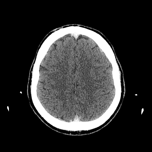 File:Cerebral venous thrombosis (CVT) (Radiopaedia 77524-89685 Axial non-contrast 36).jpg
