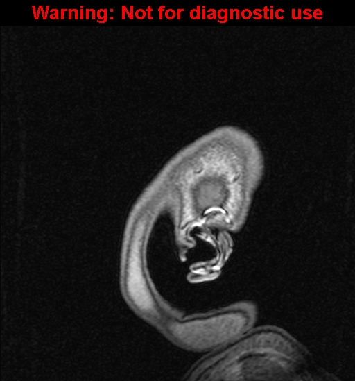 File:Cerebral venous thrombosis (Radiopaedia 37224-39208 Sagittal T1 C+ 153).jpg