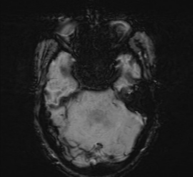 Cerebral venous thrombosis (Radiopaedia 71207-81504 Axial SWI 13).jpg