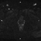 Cervical adenocarcinoma (Radiopaedia 65011-73985 Axial DWI 20).jpg