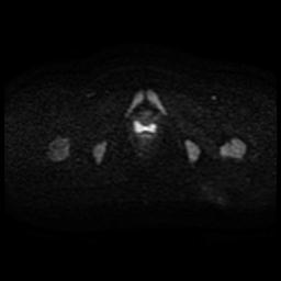 Cervical carcinoma (Radiopaedia 88010-104555 Axial DWI 42).jpg