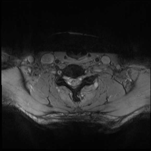 File:Cervical disc extrusion (Radiopaedia 53950-60077 Axial T2 24).jpg