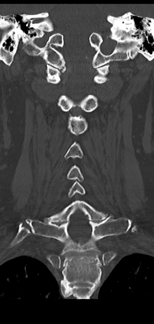 Cervical spine fracture - chalk stick (Radiopaedia 39116-41323 Coronal bone window 30).png