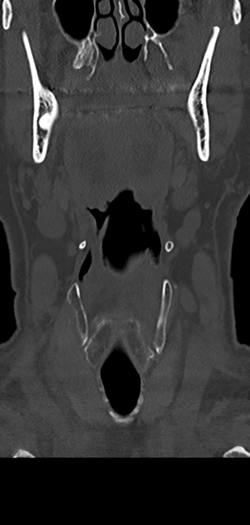 Cervical spine fracture - chalk stick (Radiopaedia 39116-41323 Coronal bone window 5).png