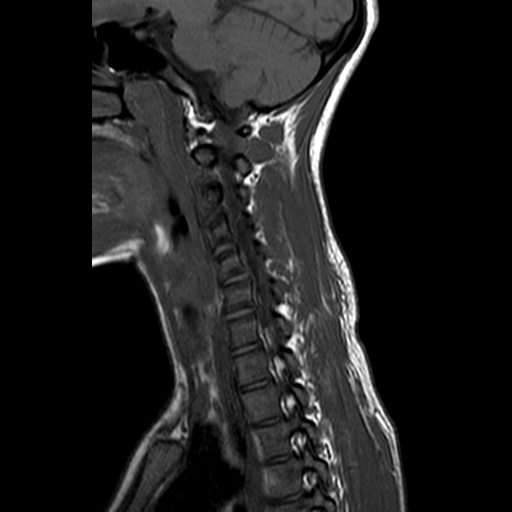 File:Cervical spine posterior ligamentous complex rupture (Radiopaedia 63486-72103 Sagittal T1 4).jpg