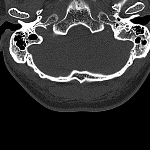 Cervical spondylodiscitis (Radiopaedia 28057-29489 Axial bone window 8).jpg