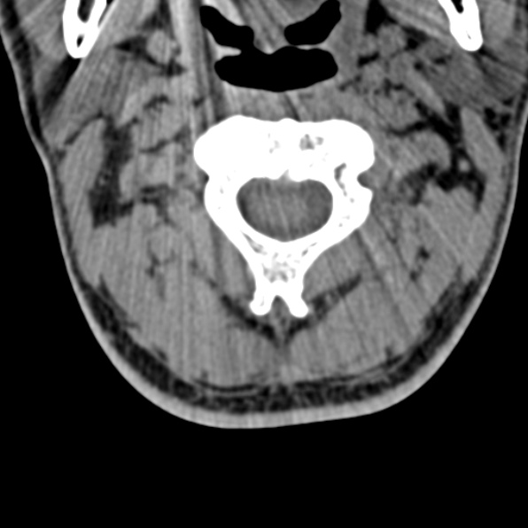 Cervical spondylodiscitis (Radiopaedia 28057-29489 Axial non-contrast 24).jpg