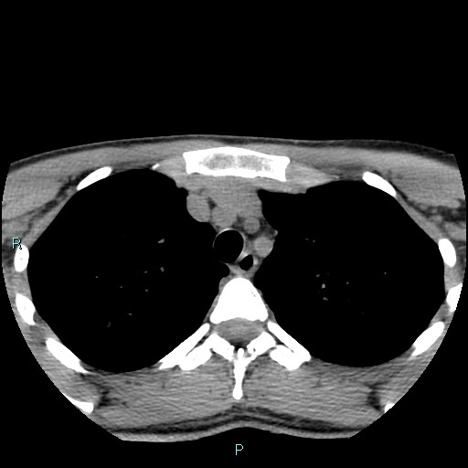 Cervical thymic cyst (Radiopaedia 88632-105335 Axial non-contrast 8).jpg