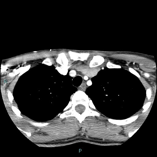 Cervical thymic cyst (Radiopaedia 88632-105335 B 14).jpg