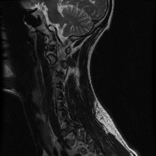 File:Cervical vertebrae metastasis (Radiopaedia 78814-91667 Sagittal T2 3).png