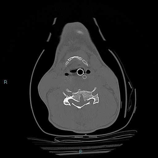 File:Cervical vertebral burst fracture (Radiopaedia 37420-39258 Axial bone window 29).jpg