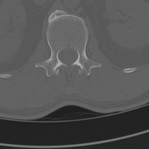 Chance fracture (Radiopaedia 33854-35020 Axial bone window 107).png