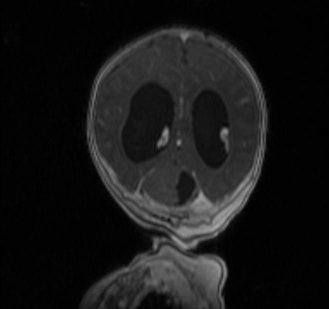 Chiari III malformation with occipital encephalocele (Radiopaedia 79446-92559 Coronal T1 C+ mpr 32).jpg