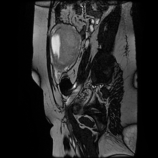 Chiari II malformation - fetal MRI (Radiopaedia 68099-77581 Sagittal Fiesta 44).jpg