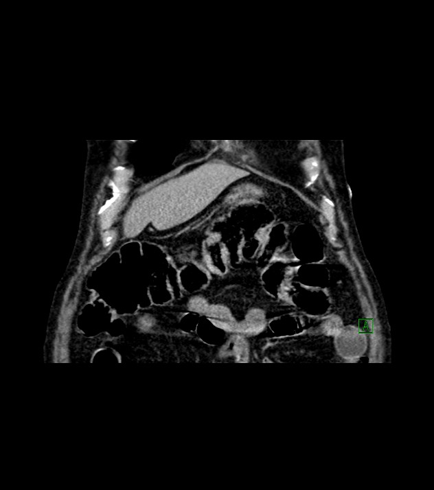 Cholangiocarcinoma with cerebral metastases (Radiopaedia 83519-98629 Coronal C+ delayed 15).jpg