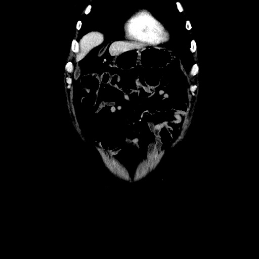 Choledocholiathiasis with normal caliber common bile duct (Radiopaedia 75368-86632 Coronal liver window 29).jpg