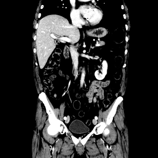 Choledocholiathiasis with normal caliber common bile duct (Radiopaedia 75368-86632 Coronal liver window 62).jpg