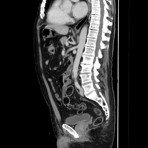 Choledocholiathiasis with normal caliber common bile duct (Radiopaedia 75368-86632 D 89).jpg