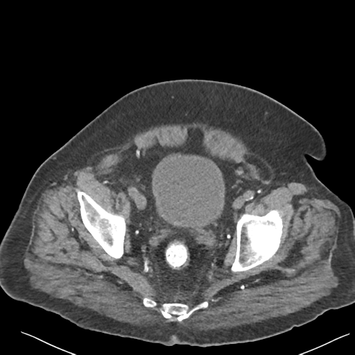 File:Choledocholithiasis and gastric polyp (Radiopaedia 48856-53895 Axial non-contrast 77).png