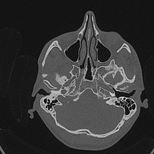 Cholesteatoma (Radiopaedia 70429-80529 Axial bone window 76).jpg