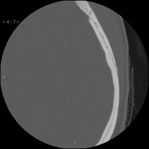 File:Cholesterol granuloma of the petrous apex (Radiopaedia 64358-73141 Axial bone window 4).jpg