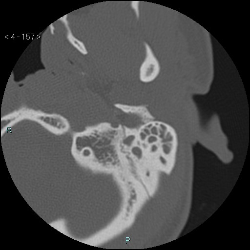 Cholesterol granuloma of the petrous apex (Radiopaedia 64358-73141 Axial bone window 76).jpg
