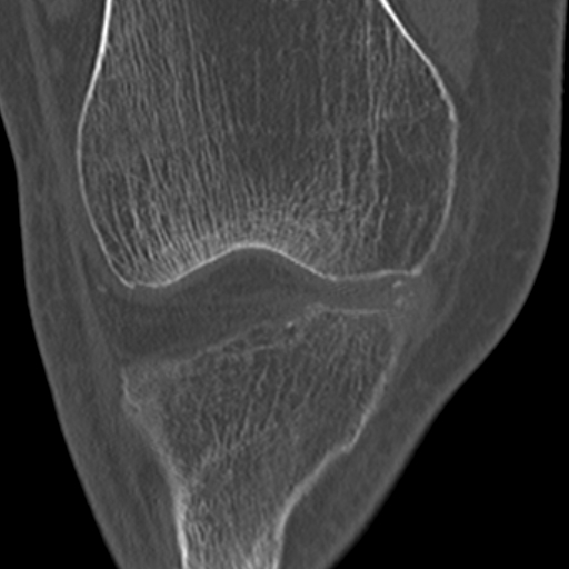 Chondrocalcinosis (Radiopaedia 16275-15955 Coronal bone window 23).jpg