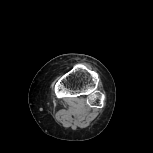 Chondrosarcoma - femur (Radiopaedia 64187-72954 Axial non-contrast 71).jpg