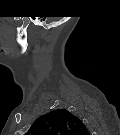 File:Chordoma (C4 vertebra) (Radiopaedia 47561-52188 Sagittal bone window 7).png
