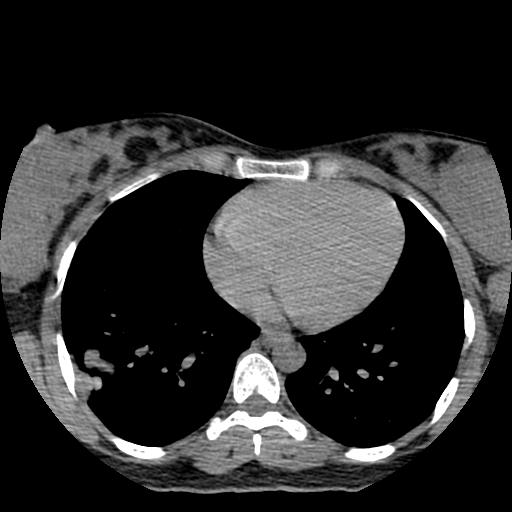 File:Choriocarcinoma of ovary with cerebral and pulmonary metastases (Radiopaedia 25983-26119 Axial non-contrast 5).jpg