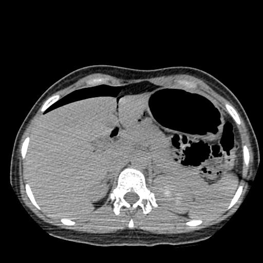 File:Choriocarcinoma of ovary with cerebral and pulmonary metastases (Radiopaedia 25983-26119 Axial non-contrast 84).jpg