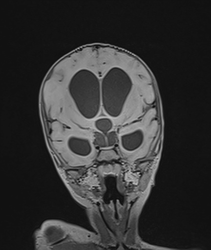 Choroid plexus papilloma (Radiopaedia 84612-100019 Coronal FLAIR 49).jpg