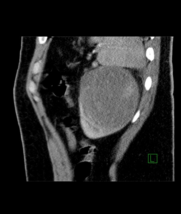 Chromophobe renal cell carcinoma (Radiopaedia 84255-99542 E 11).jpg
