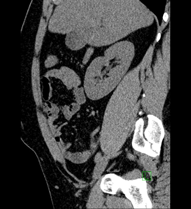 Chromophobe renal cell carcinoma (Radiopaedia 84286-99573 C 124).jpg