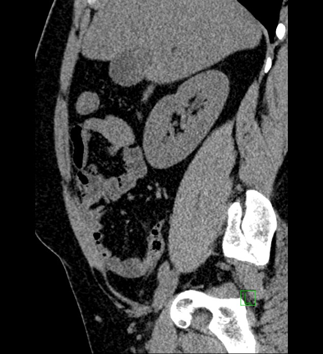 Chromophobe renal cell carcinoma (Radiopaedia 84286-99573 C 126).jpg