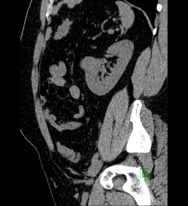 Chromophobe renal cell carcinoma (Radiopaedia 84286-99573 C 49).jpg